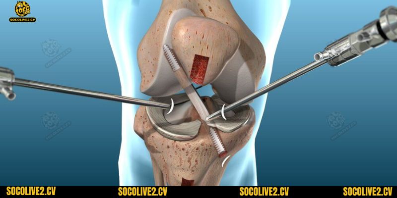 Cần can thiệp y tế ngay khi bị chấn thương dây chằng chéo để tránh các hệ lụy đáng tiếc về sau